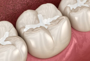 Molar Fissure dental fillings, Medically accurate 3D illustration of dental concept