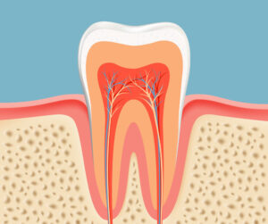 root canal