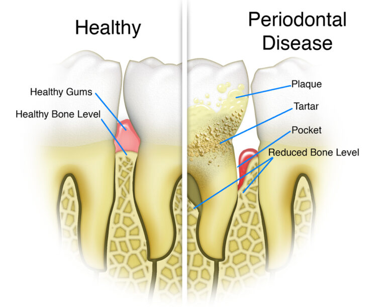 Periodontal Disease Detail