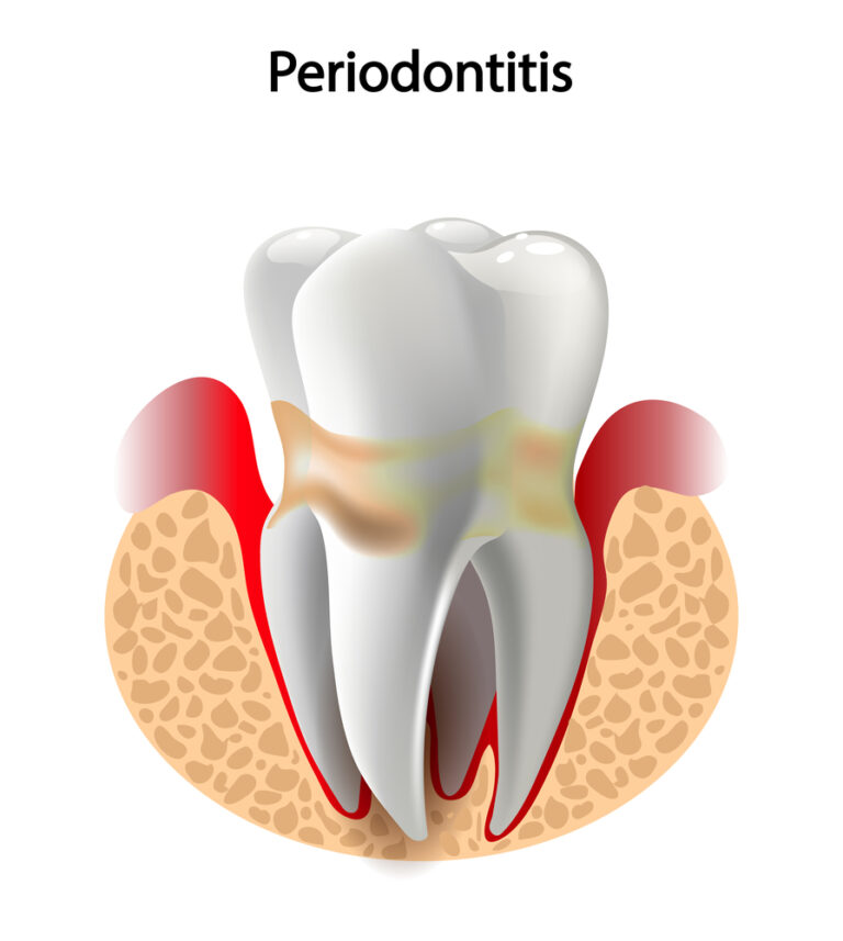 Deep caries Pulpitis Periodontitis